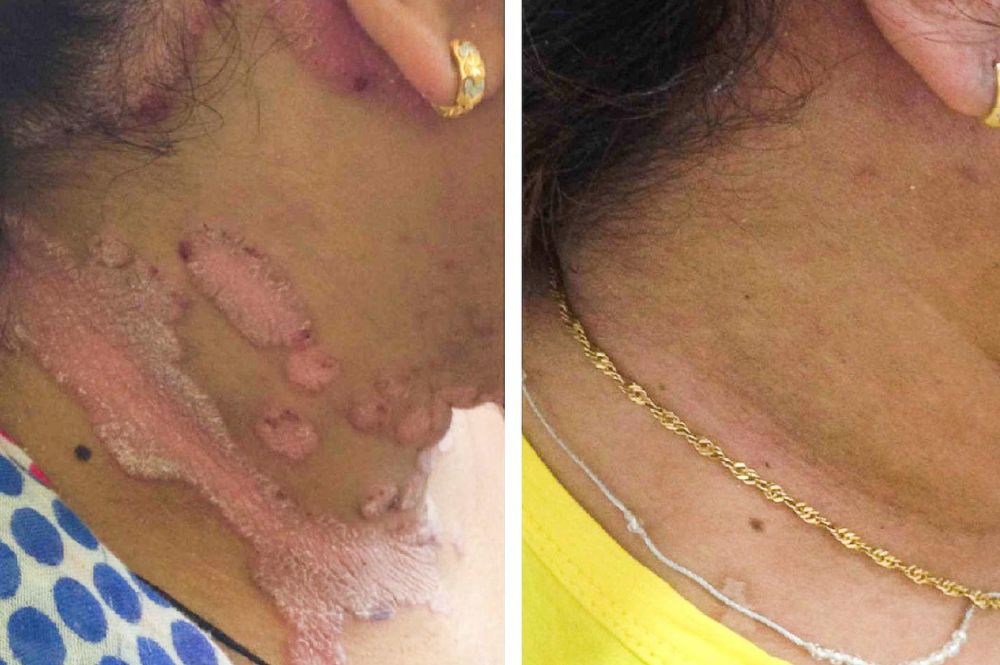 Treatment of Psorasis